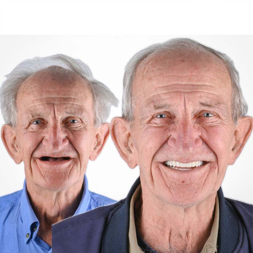 💥🦷Custom-Fit Dentures ⏰ ENDS TODAY   70% OFF | Smile with Confidence